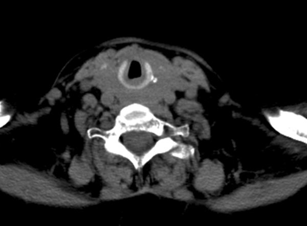 The CT Scan Showing the Absence of Significant Tracheal Compression
