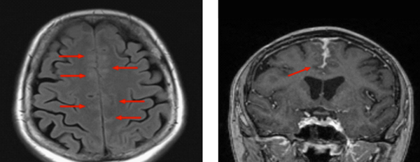 Abnormal signal in the frontal cortex bilaterally with associated hyperintensity on FLAIR images interpreted as vascular engorgement with post-contrast enhancement and thickening of the leptomeninges.