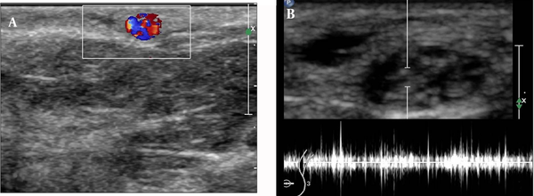 A, Color Doppler sonogram shows mixed color Doppler signals due to color motion artifact. B, Spectral trace shows irregular pattern of worm movement.