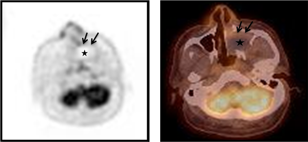 Integrated 18F-FDG-PET/CT images show moderate uptake only at the peripheral rim (black arrows) of the mass with negative FDG uptake in the central portion (asterisk). The maximum standardized uptake value (SUVmax) of this lesion is 3.80. Other signs of abnormal uptake suggesting a malignant lesion are not observed.