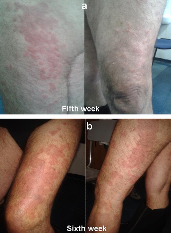 a) Eczematiform Itchy Lesion on the Thigh, Buttock, Back of the Foot, in Both Lower Limbs, Especially on the Left at Fifth Week; b) Eruption Progression to Grade 3 at Sixth Week: Rash involved More Than 50 % of Body Surface Area, Presenting Vescicles and Superficial Ulceration
