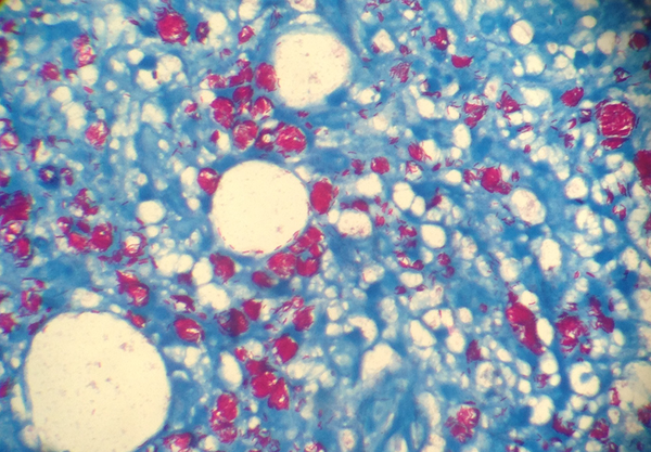 Ziehl–Neelsen staining revealed numerous acid fast bacilli, both intracellularly and extracellularly.