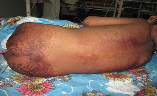 Erythematous Maculopapular Rash With Purpuric Spots Over the Back