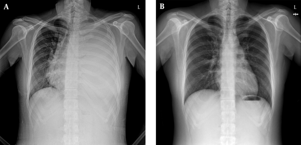 A, A Chest X-Ray Showed Nearly Total Increased Opacity in Left Lung and Slightly Deviation to Right Side of Heart; B, Follow-Up Chest X-Ray at Post RAI Therapy Four Weeks Showed no Residual Chylothorax.