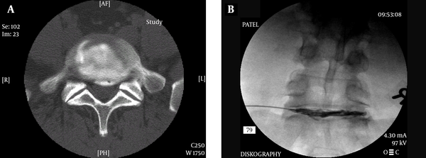 A and B, Post Discogram CT Scan Image Showing Annular Disruption