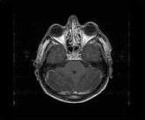 Bilateral Patchy Enhancement in the Cerebellum Hemispheres
