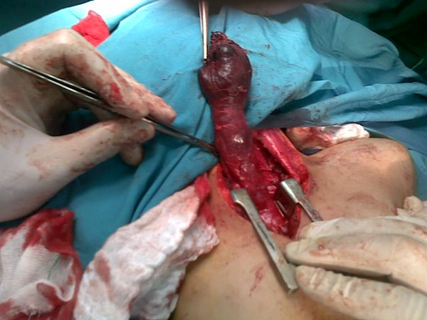 Complete Removal of Cervical Mass Originated From Thymus