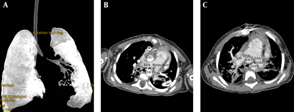 Compressive Effect of the Dilated RPA on the Left Main Bronchus on Virtual CT Bronchography (A) and CT Angiography (B) that Was Relieved After Anterior RPA Translocation (C)