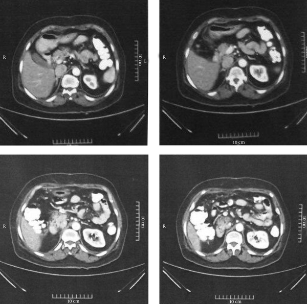 Abdominal CT Images for Patient Number 4 at the 18-Month Follow-up Visit