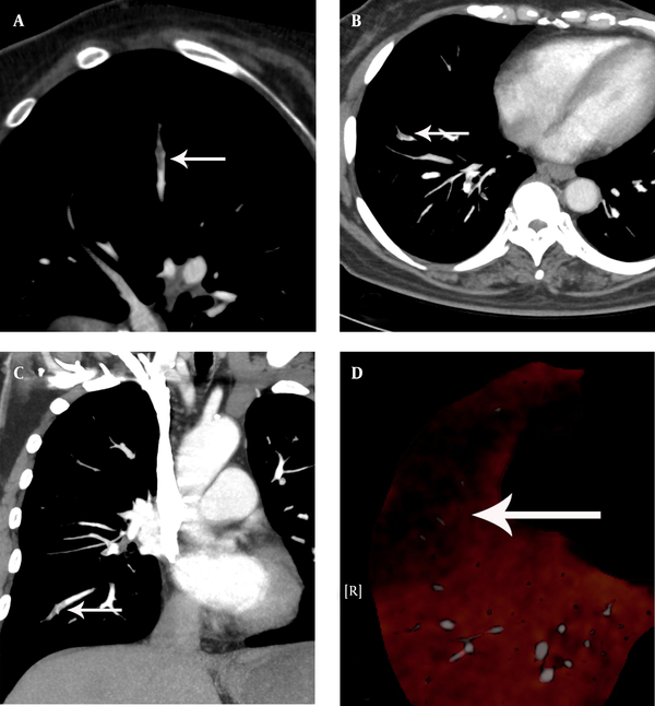 A 60-year-old woman with chest distress and shortness of breath for one week, who had a history of breast cancer, worsened for one day. A, The pulmonary embolism detection software image displayed a partial eccentric filling defect and significantly narrow lumen at the anterior basal artery of the lower lobe of the right lung. B, C, The computerized tomography pulmonary angiography image showed a filling defect at the anterior basal artery of the lower lobe of the right lung. D, The dual-energy pulmonary perfusion imaging image revealed obvious sparse perfusion and a partial perfusion defect at the anterior basal segment of the lower lobe of the right lung.