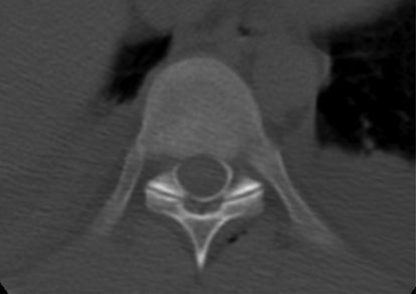 Spread of Contrast Material on a Transverse CT Slice of the Spine is Mainly Situated in the Posterolateral Regions of the Epidural Space