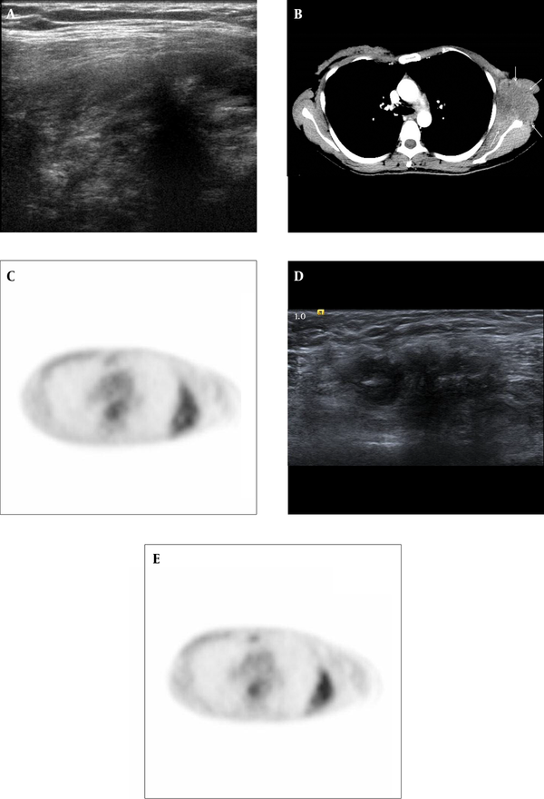 A 38-year-old woman with a history of left sided breast cancer treated with modified radical mastectomy underwent ultrasonography for further evaluation of palpable left chest wall mass. A, Breast US on November 2011. US showed a huge infiltrative heterogeneous hypoechoic mass at previous lymph node dissection site of left axilla, extending into left chest wall. B, Chest CT on November 2011; Chest CT showed a 10-cm irregular hypodense chest wall mass with intense peripheral enhancement beneath mastectomy site. There was no evidence of adjacent bone destruction. C, PET/CT on June 2011; PET/CT showed mild FDG uptake of a SUVmax of 3.1 at left lateral chest wall. D, US on May 2011 and E, PET/CT on June 2011; D and E on the postoperative follow-up examination undertaken 6 months before, this mass was misinterpreted as postoperative scar and fat necrosis. D, US showed a 3.5 cm irregular hypoechoic lesion at left axilla and E, PET/CT showed mild FDG uptake of a SUVmax of 2.6 at left lateral chest wall. The size and FDG uptake of this lesion was increased 6 months later (3.5 cm to 10 cm in size, 2.6 to 3.1 in SUVmax).
