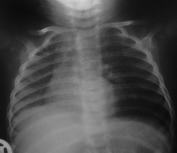 Antero-Posterior CXR Demonstrates Hypoplastic Right Lung and Mediastinal Shift