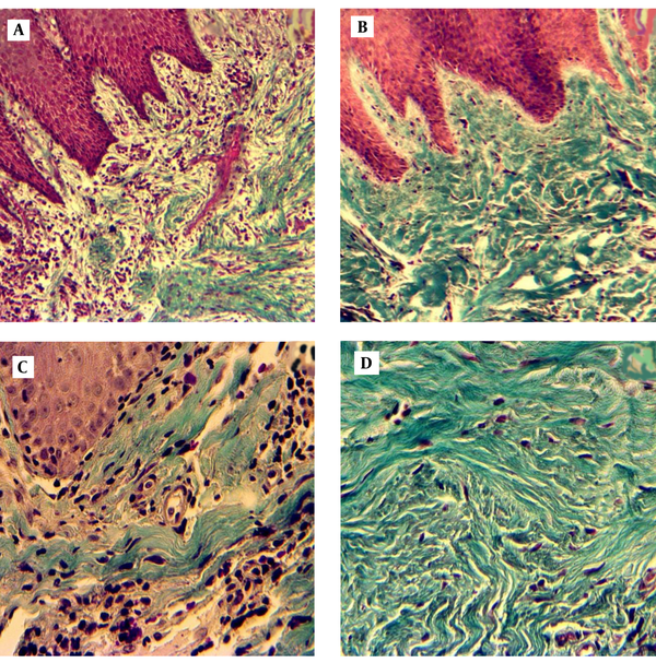 A. Patient gingival tissue: original magnification X 10, loss of collagen bundles and accumulation of immune cells. B. Healthy gingival tissue: original magnification X 10, integrity of collagenous matrix, and low cellular population. C. Patient gingival tissue: original magnification X 40 D. Healthy gingival tissue: original magnification X 40.