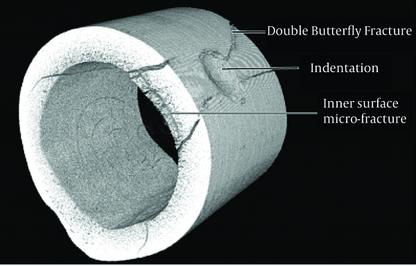 Micro-CT Image of the Impact Site of a Deer Femur Shot at 165 ft/s (50 m/s), Showing a Crack at the Edge of the Resultant Indentation, the Double Butterfly and Inner Surface Micro-Damage Fractures