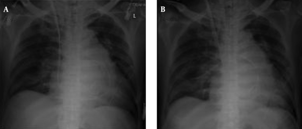 A, The postoperative image showed appropriate placement of the pulmonary artery catheter; B, the image taken on postoperative day 1 showed that the catheter tip had moved peripherally.