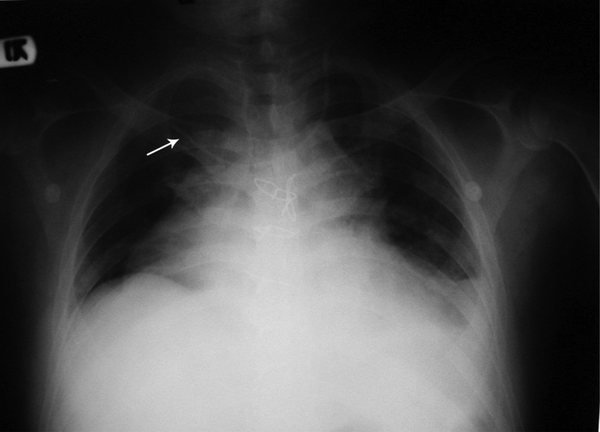 Central venous catheter inserted through a left internal jugular approach. Arrow shows the tip of the catheter in the right subclavian vein.