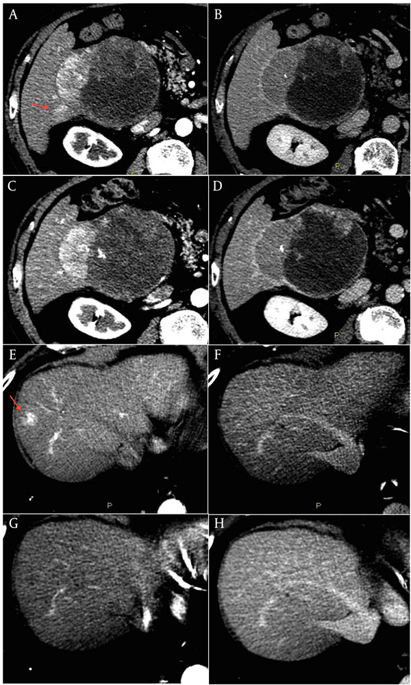 The last contrast-enhanced CT scan performed in January 2013 showed a reduction in vascularity of the large lesion with an increase of tumor necrosis, and a significant shrinkage of the satellite lesion (C and D). The lesion in segment VIII was no longer clearly distinguishable from the surrounding tissue (G and H).
