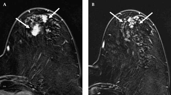 A 69-year-old woman with A, invasive ductal carcinoma in the upper outer quadrant of left breast (arrows); B, The axial post-contrast subtracted image depicts segmental clumped enhancement (arrows) in the same quadrant as the index cancer. The surgical biopsy revealed ductal carcinoma in situ.