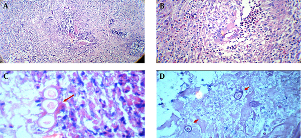 A, granulomatous inflammatory response with marked eosinophilic infiltration; B, multinucleated giant cell contains worm body with marked eosinophilic infiltration; C, degenerated worm body. D: Capillaria hepatica’s ova in a massive necrotic background.