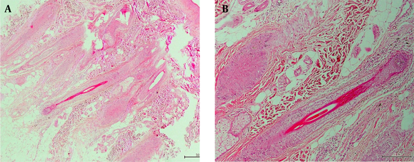 A, B, Histopathological examination of an excisional scalp biopsy showed a slight orthokeratosis in the epidermis and a normal number of catagen follicles in the dermis. There was no anagen hair on the alopecic patches and no inflammation on the periphery of the catagen follicles. The findings were consistent with an anagen effluvium (AE).