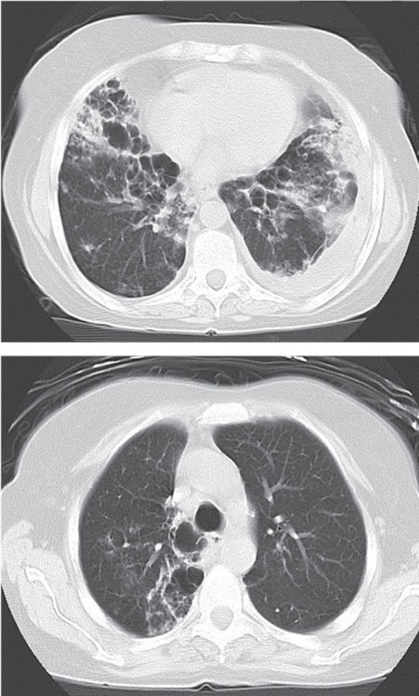 Computed Chest Tomography After Treatment of Nocardiosis Revealed Underlying Bronchiectasis With No Alveolar Infiltrations or Nodular Opacities.