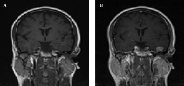 Coronal Sequence of T1 Brain MRI Without Gadolinium (A) and With Gadolinium (B)