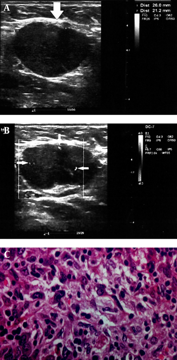 Sonographic Evaluation Of Cervical Lymphadenopathy Comparison Of