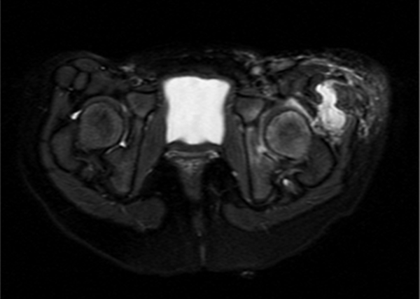 MRI Axial T2 Fat Suppression Sequence Showing Edema of Femoral Head and Acetabulum; Extensive Affectation of Periarticular Muscles and Subcutaneous Tissue