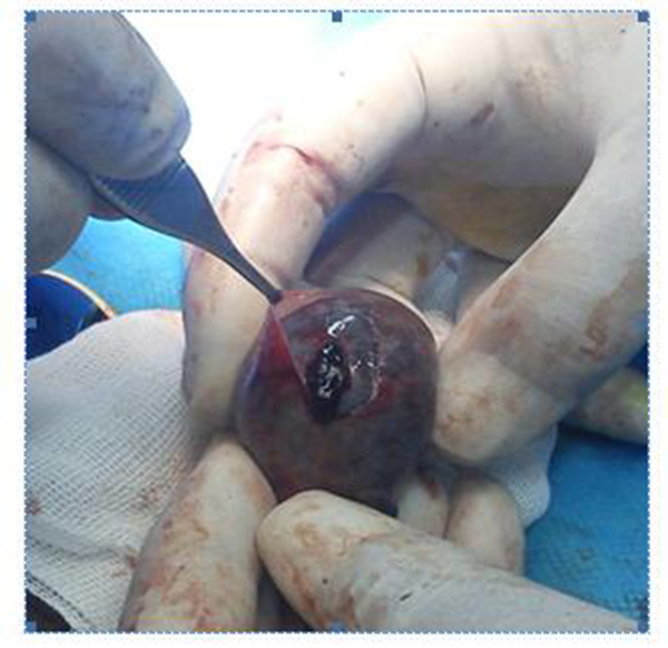 (Case One) Left Testis Extravaginal Torsion (Tunica Vaginalis is Showed after Orchicdectomy)