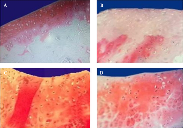Intact articular cartilage with intense red (S-O) staining indicates the concentration of PG. A, A uniform red staining was seen in all regions of normal articular cartilage; B, Increases loss of red staining was seen in OA group; C, Significant increase of PG in MSCs and D, slight increase of PG in (M + C.S.).