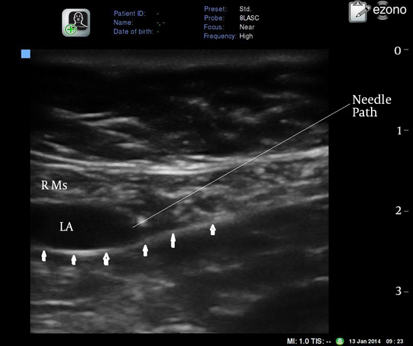 R Ms: rectus abdominis muscle. Arrows: posterior rectus sheath. LA: local anesthetic.