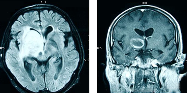Axial and Coronal Views of Contrast Enhanced Brain MRI