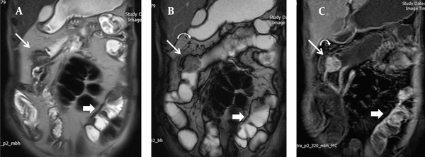 There is considerable mural thickening with mass like appearance at ileocolic anastomotic area with intense contrast enhancement leading to luminal stricture (thin arrow). Adjacent mesenteric enlarged lymph nodes are also depicted (curved arrow). Another short segment mural thickening is evident in mid ileum with predominant involvement of mesenteric side showing increased contrast enhancement (thick arrow).