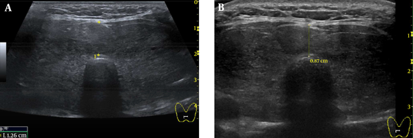 A, Ultrasonography of the Thyroid Revealed a Diffusely Enlarged Thyroid Gland to Approximately 61 mL (3.4 × 2.4 × 6.8 cm, Width × Depth × Length, 1.26 cm, Isthmus Thickness) Without Definite Evidence of Nodular Lesions; B, Ten Weeks After RAI Therapy, a Follow-Up Ultrasonography of the Thyroid Showed a Decreased Size of Diffuse Goiter Compared to Initial Ultrasonography (36 mL Volume of Both Thyroid Gland, 2.8 × 2.0 × 6.1 cm, Width × Depth × Length, 0.87 cm, Isthmus Thickness).