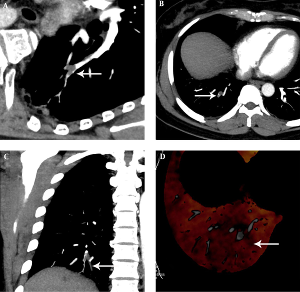 A 54-year-old woman with chest distress for two weeks aggravated for one day, who had a history of varicose veins of the lower extremity. A, The pulmonary embolism detection software image showed an irregular filling defect which rode across the arterial bifurcation and luminal narrowing at the posterior basal segment artery of the lower lobe of the right lung. B, C, The computerized tomography pulmonary angiography image found an irregular filling defect which rode across the arterial bifurcation and luminal narrowing at the posterior basal segment artery of the lower lobe of the right lung. D, The dual-energy pulmonary perfusion imaging image revealed mild pulmonary sparse perfusion and significant sparse portion at the posterior basal segment of the lower lobe of the right lung.