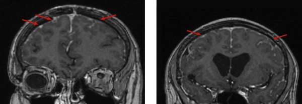 Thirteen Month Follow Up MRI Images (Coronal T1) Demonstrating Regression of The Previous Leptomeningeal Enhancement and Subsequent Progression in New Regions Particularly in The Right Parietal Lobe, With Coinciding Diffusion Restriction