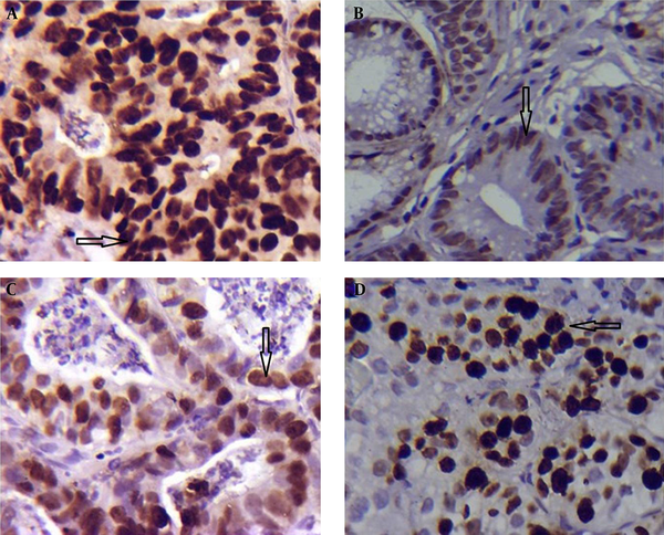 p53 expression in cases with H. pylori infection (A) and those without H. pylori infection (B); Ki-67 expression in cases with H. pylori infection (C) and those without H. pylori  infection (D) (arrows); magnification × 400.