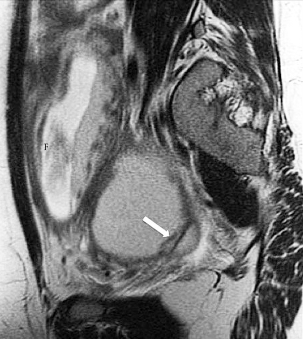 Sagittal T2-weighted image demonstrates a unilocular hemorrhagic cyst (arrow) at the posterolateral aspect of the large, dominant cystic mass with reduced T2 signal intensity (“T2 shading”). An intrauterine fetus is also noted (F).