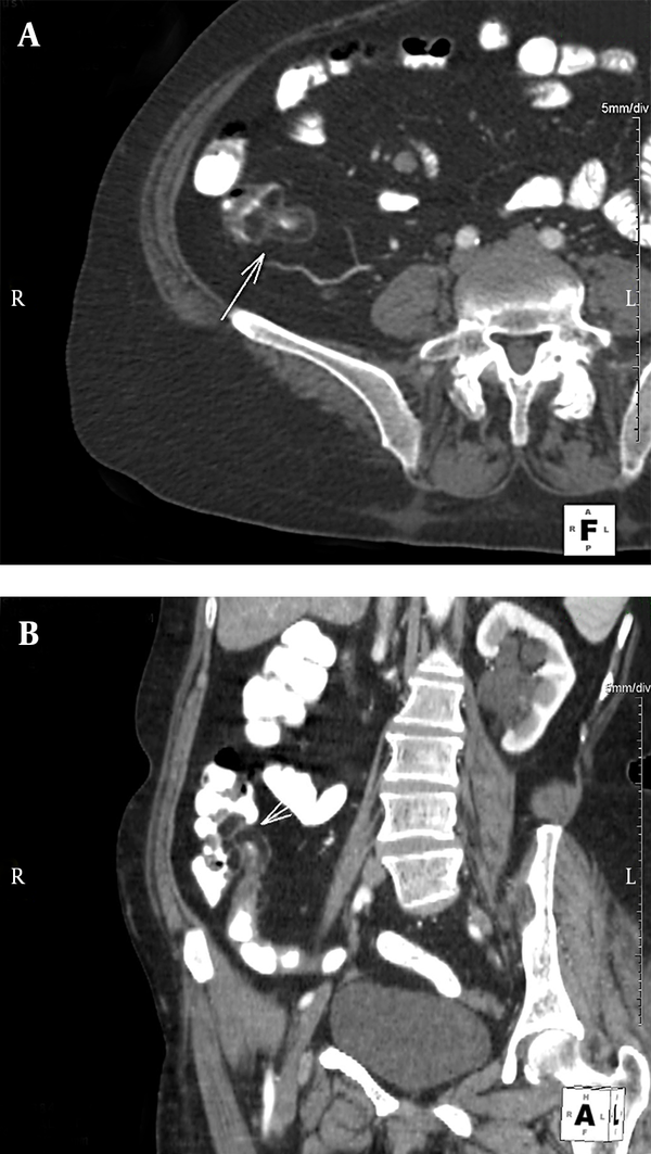 A 70-year-old woman with lipomatosis of terminal ileum and ileocecal valve. Intravenous contrast enhanced MDCT scans: A) Axial reformatted image; B) Coronal oblique reformatted image. They show diffuse intramural fatty infiltration in the terminal ileum and ileocecal valve (arrows). Note parapelvic cysts in the left kidney in Figure.B.