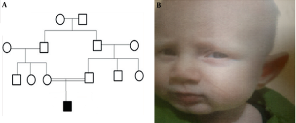 A, Family pedigree of the affected individual; B, The patient at the age of two months.