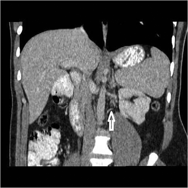Coronal MPR reconstruction of contrast enhanced CT image shows the artery of the left lower kidney originating from the abdominal aorta (white arrow).