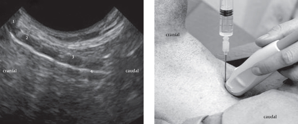 This figure shows Thyroid cartilage (1), Cricoid cartilage (2), second tracheal cartilage ring (3), and the echogenic line is consistent with an air-tissue interface at the anterior tracheal wall. The cartilages are echolucent. Location of needle insertion is between first and second cartilage ring.