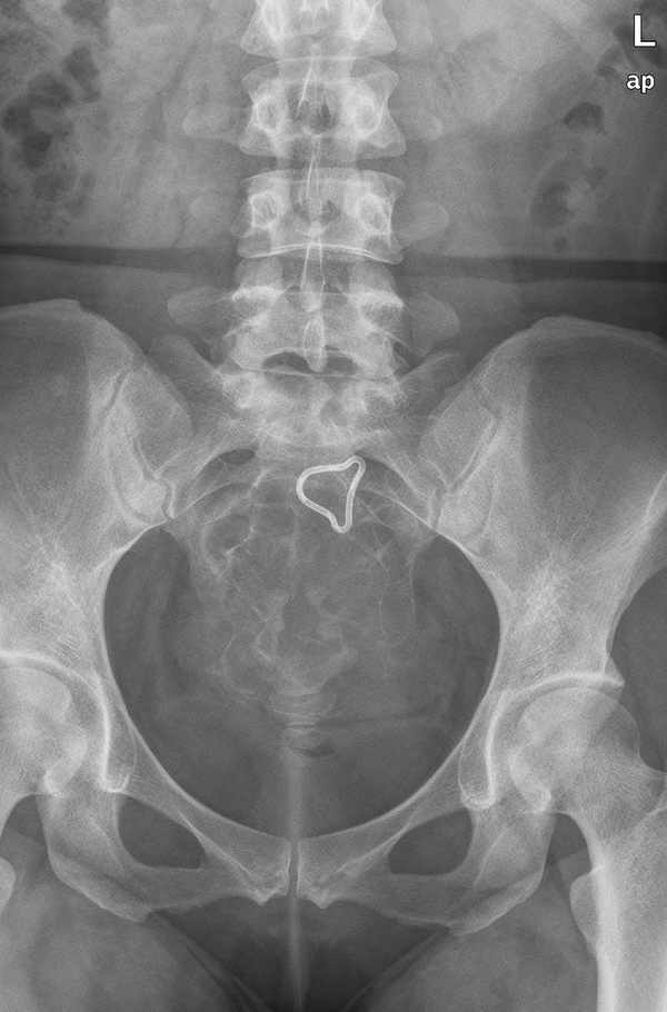 Radiograph shows markedly expansile, well-marginated, mixed lytic and sclerotic lesion of the sacrum.