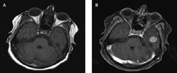 Axial Sequence of T1 Brain MRI Without Gadolinium (A) and With Gadolinium (B)