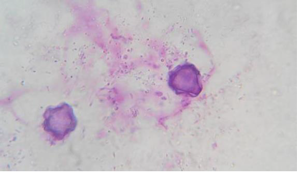 Cyst of Acanthamoeba asteronyxis in the Gimsa stained smear (100X)
