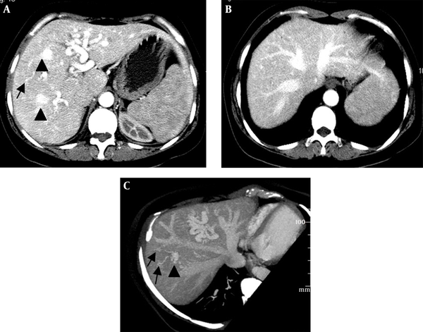 Intrahepatic arteriovenous shunts. A and B, Contrast-enhanced CT shows a dilated hepatic artery and early opacification of the main hepatic veins during the arterial phase; C, Oblique maximal intensity projection MDCT in the parasagittal plane shows a dilated hepatic artery and early simultaneous opacification of the hepatic veins; A and C, Large confluent vascular masses (black arrowheads) and multiple telangiectasias (black arrows) in the peripheral parenchyma are visible.