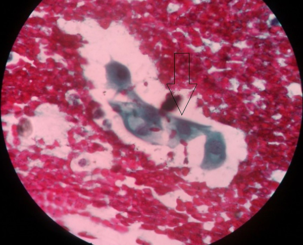Arrow indicated cell, which has completely changed to a carcinoma (hematoxylin and eosin, ×500).