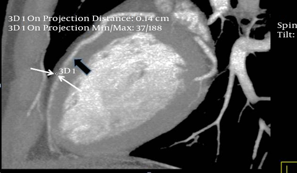 Update on Myocardial Bridging