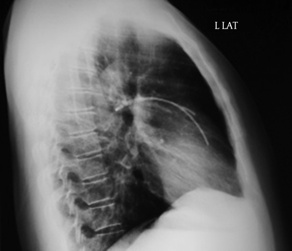 Successfully removed fragment of dislodged chemoport catheter